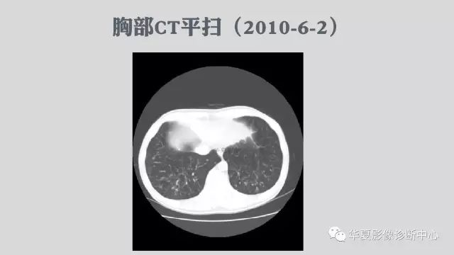 【病例】侵袭性肺曲霉菌病例追踪CT影像表现
