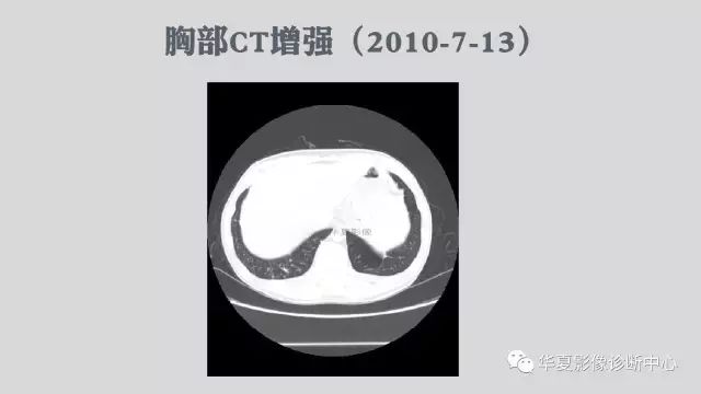 【病例】侵袭性肺曲霉菌病例追踪CT影像表现