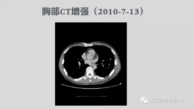 【病例】侵袭性肺曲霉菌病例追踪CT影像表现