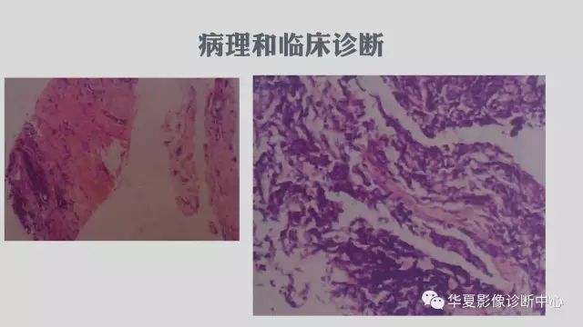 【病例】侵袭性肺曲霉菌病例追踪CT影像表现