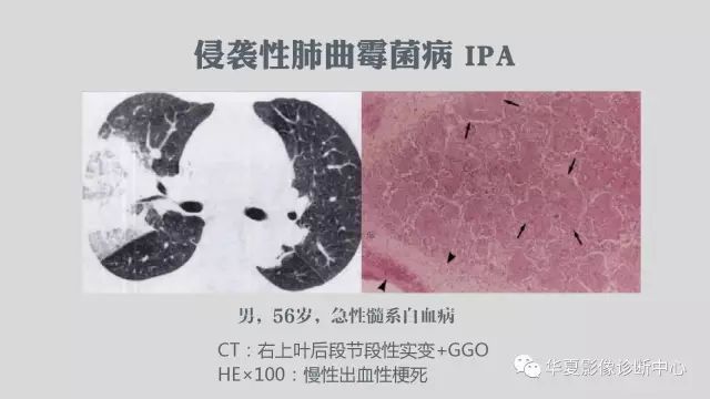 【病例】侵袭性肺曲霉菌病例追踪CT影像表现