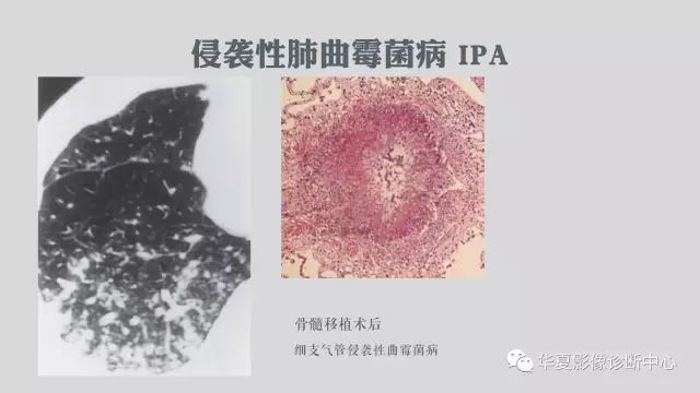 【病例】侵袭性肺曲霉菌病例追踪CT影像表现