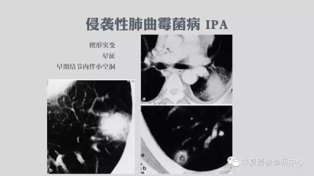 【病例】侵袭性肺曲霉菌病例追踪CT影像表现
