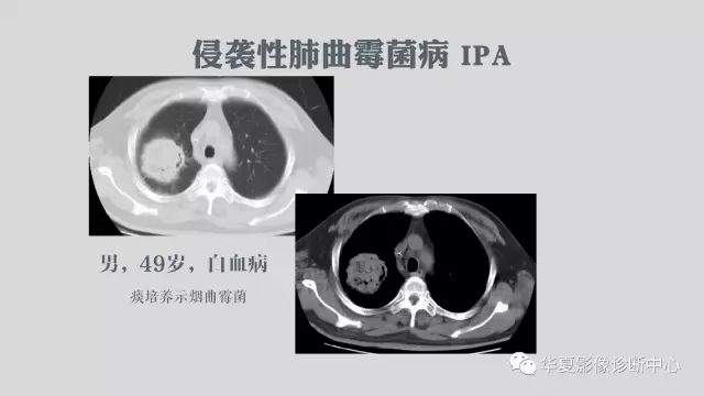 【病例】侵袭性肺曲霉菌病例追踪CT影像表现