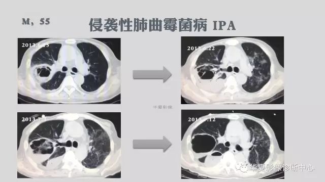 【病例】侵袭性肺曲霉菌病例追踪CT影像表现