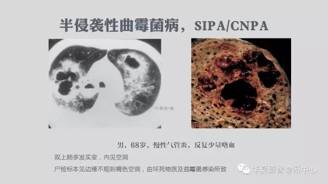 【病例】侵袭性肺曲霉菌病例追踪CT影像表现