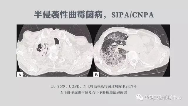 【病例】侵袭性肺曲霉菌病例追踪CT影像表现