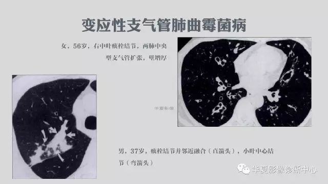 【病例】侵袭性肺曲霉菌病例追踪CT影像表现