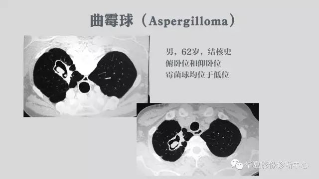 【病例】侵袭性肺曲霉菌病例追踪CT影像表现