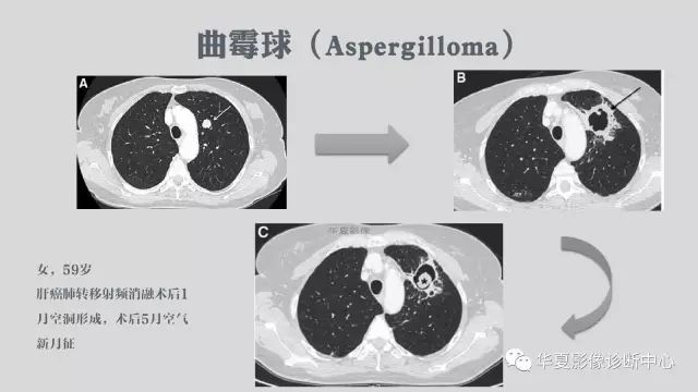 【病例】侵袭性肺曲霉菌病例追踪CT影像表现