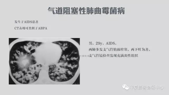 【病例】侵袭性肺曲霉菌病例追踪CT影像表现