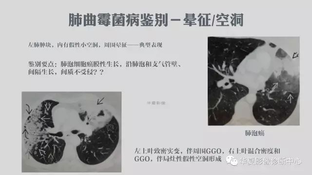 【病例】侵袭性肺曲霉菌病例追踪CT影像表现