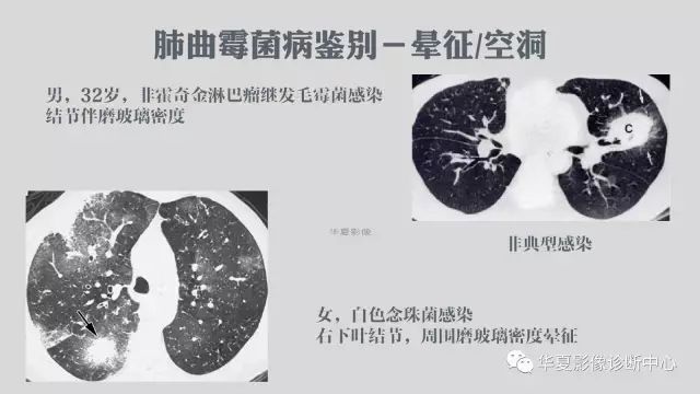 【病例】侵袭性肺曲霉菌病例追踪CT影像表现