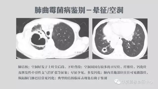【病例】侵袭性肺曲霉菌病例追踪CT影像表现