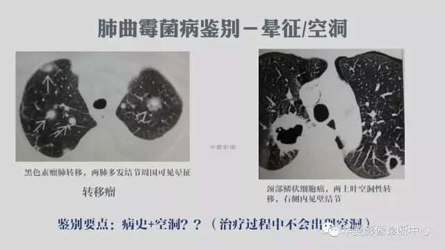 【病例】侵袭性肺曲霉菌病例追踪CT影像表现