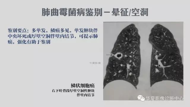 【病例】侵袭性肺曲霉菌病例追踪CT影像表现