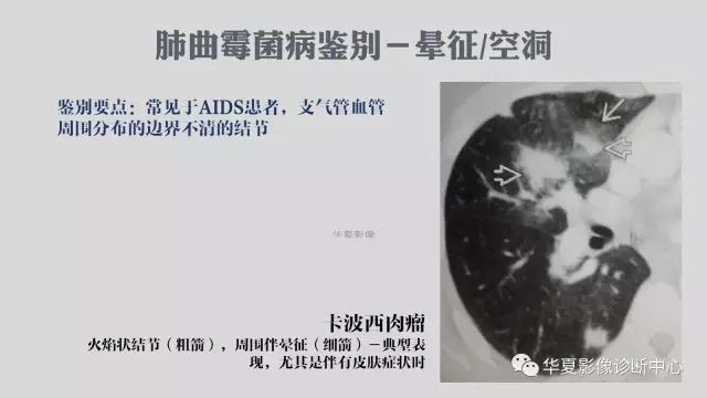 【病例】侵袭性肺曲霉菌病例追踪CT影像表现