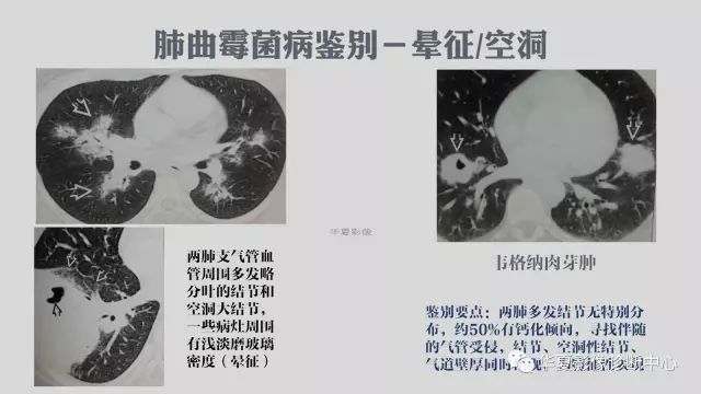 【病例】侵袭性肺曲霉菌病例追踪CT影像表现