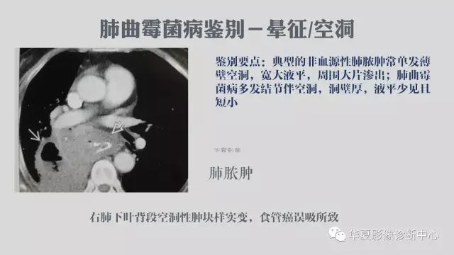 【病例】侵袭性肺曲霉菌病例追踪CT影像表现