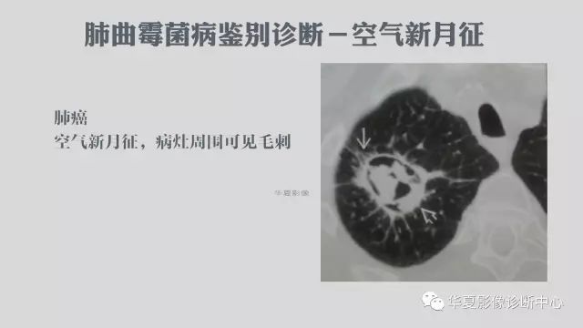 【病例】侵袭性肺曲霉菌病例追踪CT影像表现