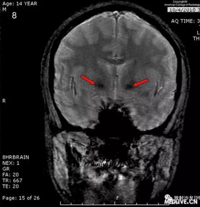 【病例】线粒体脑肌病1例CT及MR影像表现 【病例】线粒体脑肌病1例CT及MR影像表现