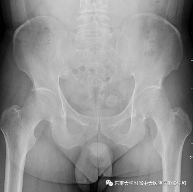 【病例】髋关节撞击综合征1例X线MR