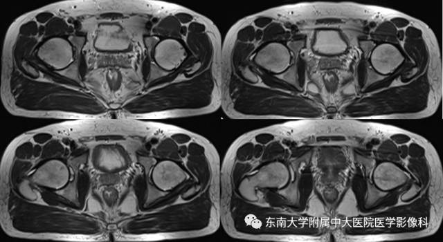 【病例】髋关节撞击综合征1例X线MR