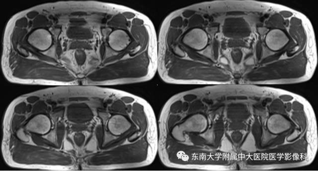 【病例】髋关节撞击综合征1例X线MR