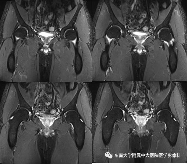 【病例】髋关节撞击综合征1例X线MR