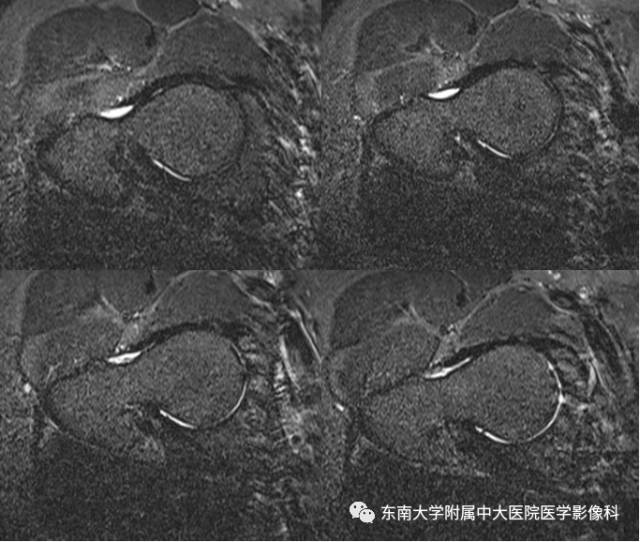【病例】髋关节撞击综合征1例X线MR