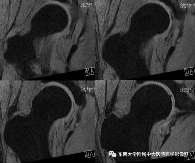 【病例】髋关节撞击综合征1例X线MR