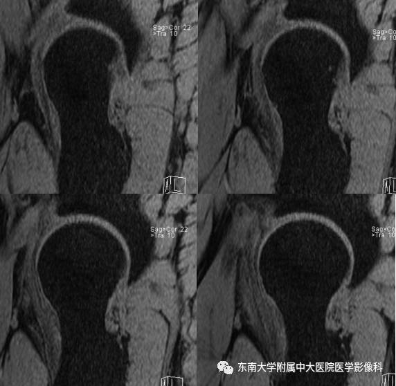 【病例】髋关节撞击综合征1例X线MR