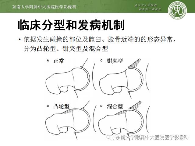 【病例】髋关节撞击综合征1例X线MR