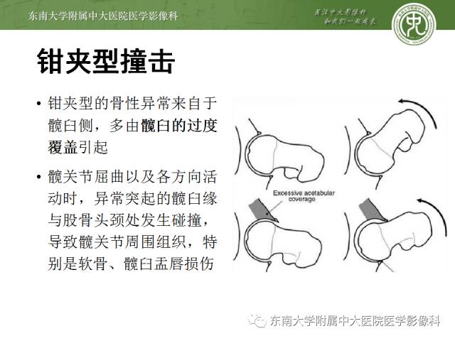 【病例】髋关节撞击综合征1例X线MR