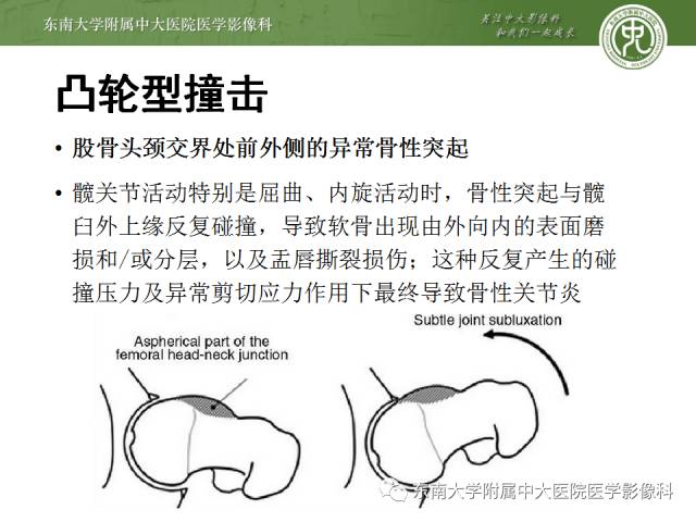 【病例】髋关节撞击综合征1例X线MR