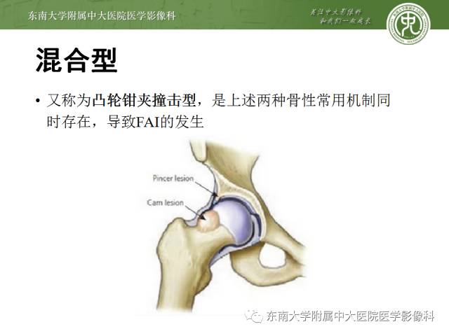 【病例】髋关节撞击综合征1例X线MR