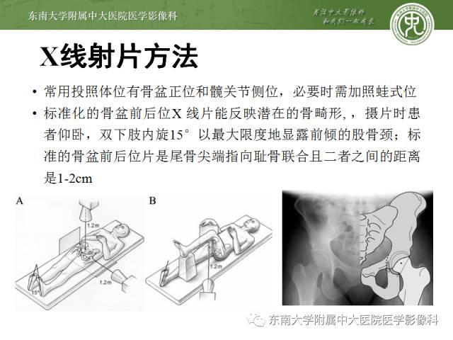 【病例】髋关节撞击综合征1例X线MR