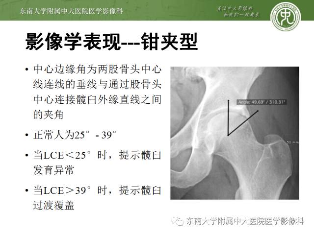 【病例】髋关节撞击综合征1例X线MR