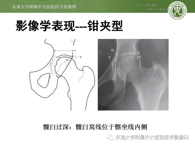 【病例】髋关节撞击综合征1例X线MR