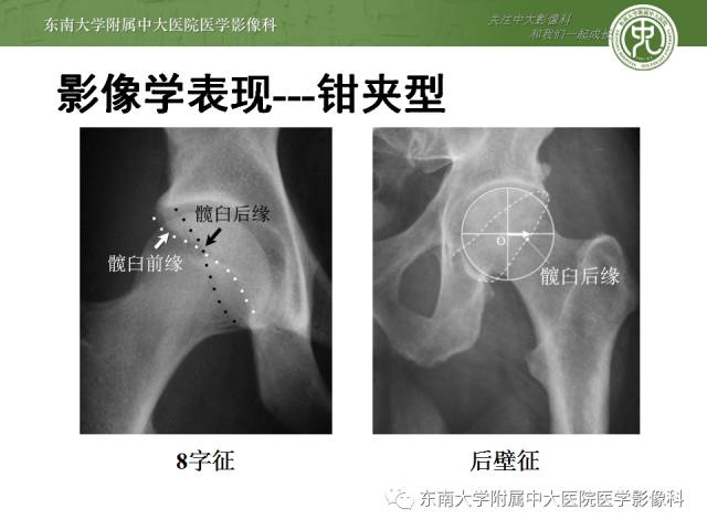 【病例】髋关节撞击综合征1例X线MR