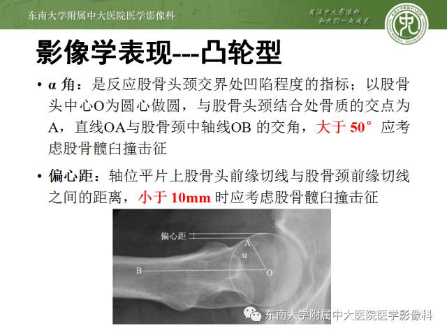 【病例】髋关节撞击综合征1例X线MR