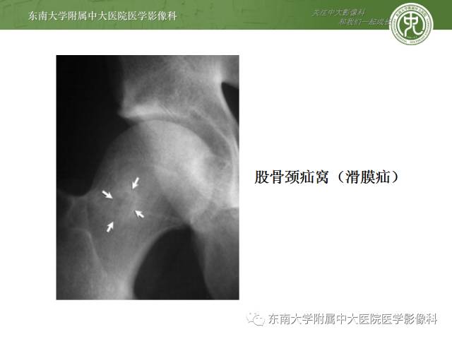 【病例】髋关节撞击综合征1例X线MR