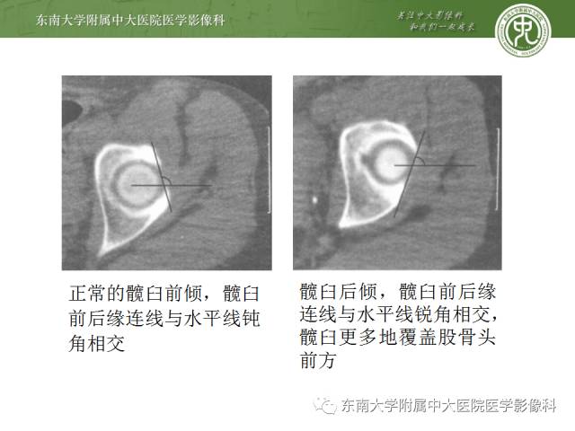 【病例】髋关节撞击综合征1例X线MR