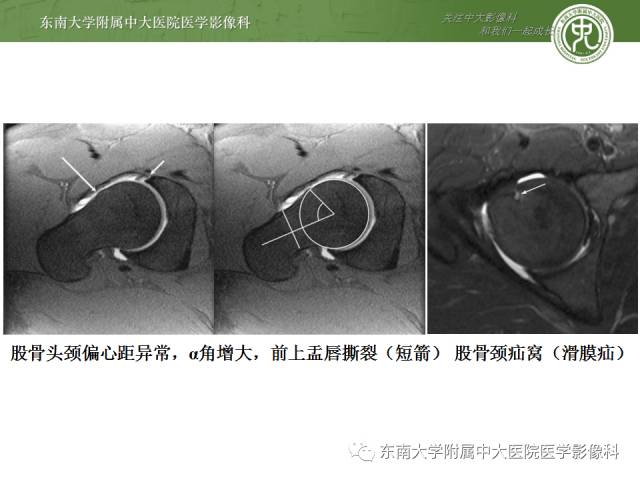 【病例】髋关节撞击综合征1例X线MR