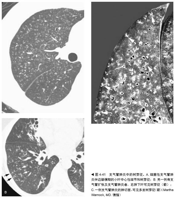常见肺部疾病的不同树芽征表现,你都掌握了吗? 常见肺部疾病的不同树芽征表现,你都掌握了吗?