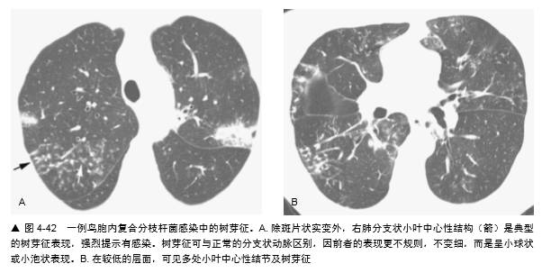 常见肺部疾病的不同树芽征表现,你都掌握了吗? 常见肺部疾病的不同树芽征表现,你都掌握了吗?