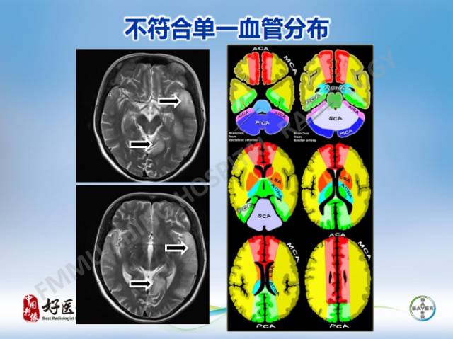 【病例】线粒体脑肌病1例MR
