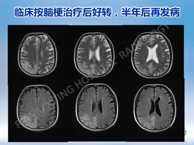 【病例】线粒体脑肌病1例MR