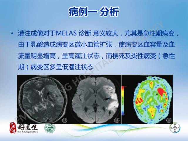 【病例】线粒体脑肌病1例MR