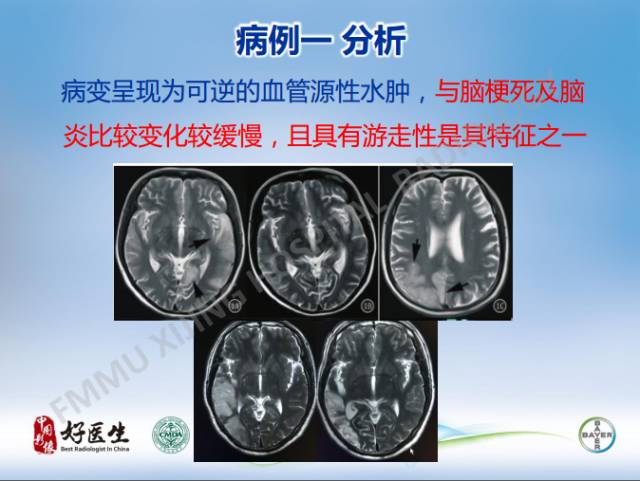 【病例】线粒体脑肌病1例MR